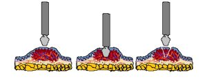 Imagen ilustrativa de Biopsia incisional