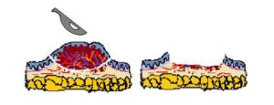 Imagen ilustrativa de Biopsia escicional