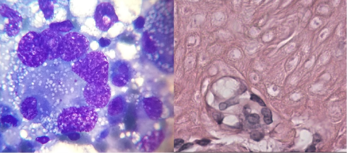 Citología o Biopsia en el paciente oncológico