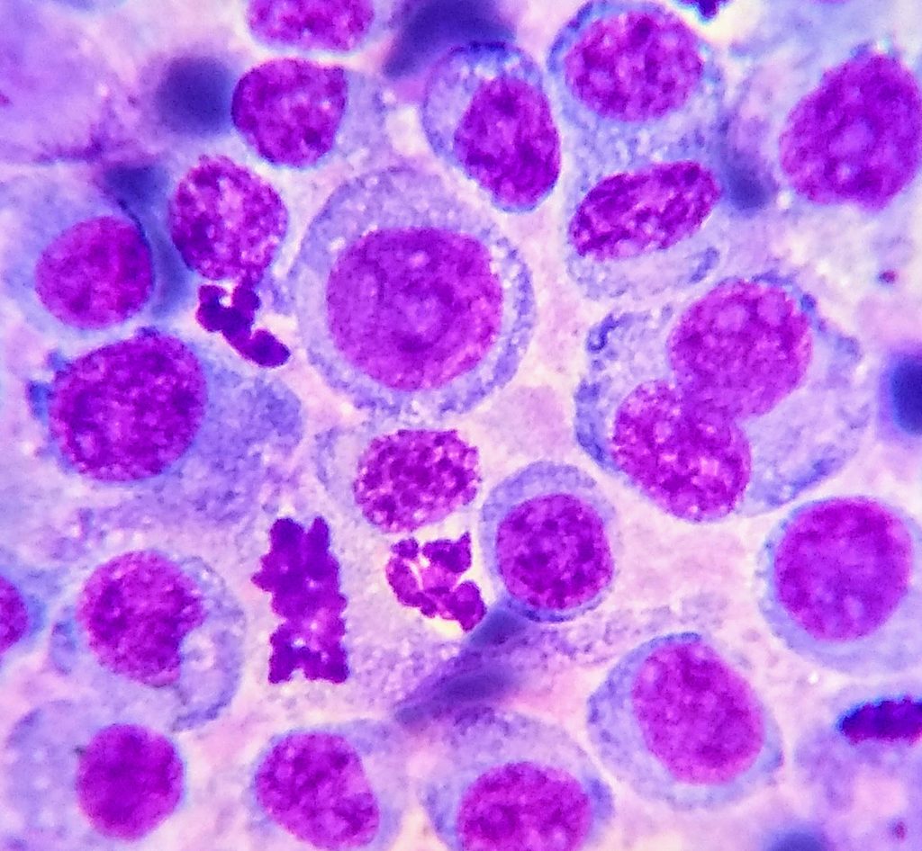 Análisis de muestra obtenida por biopsia ecoguiada